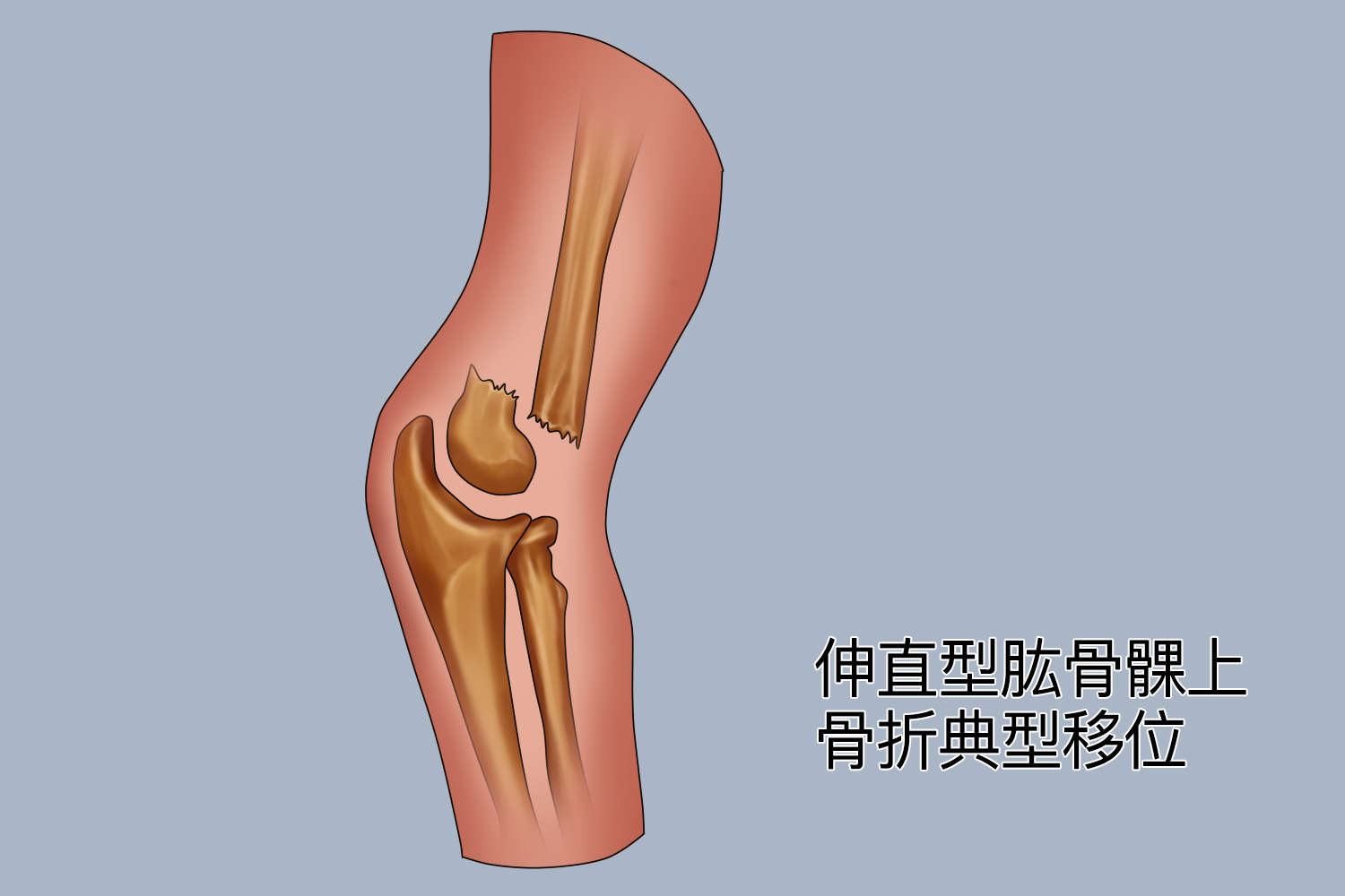 伸直型肱骨髁上骨折图 伸直型肱骨髁上骨折图