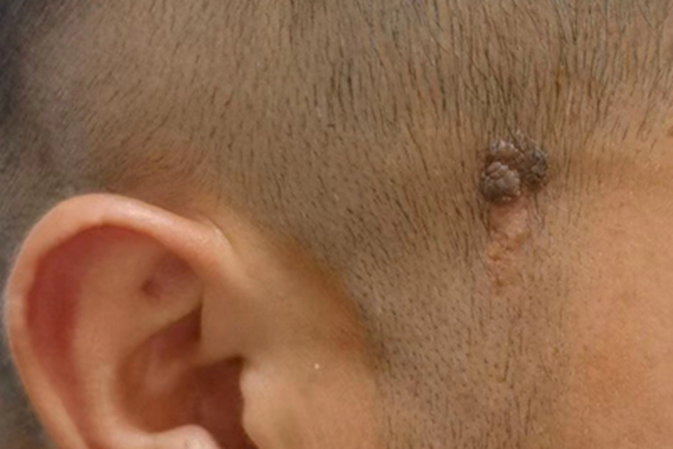 皮脂腺痣头部疙瘩图