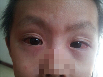 儿童过敏性结膜炎眼睛红红的有水肿图.png