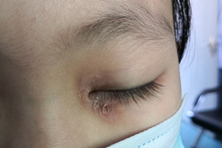 慢性眼睑湿疹眼睑脱皮图