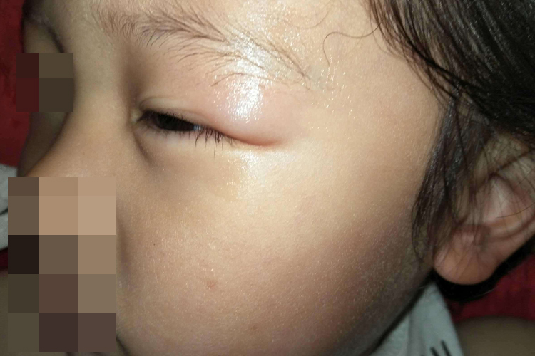 幼儿EB病毒感染眼皮肿图