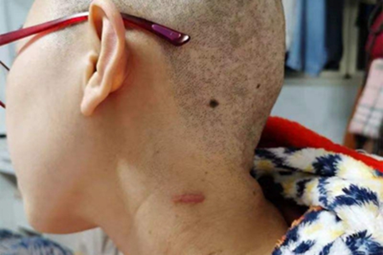 瘢痕疙瘩侧颈疙瘩图 瘢痕疙瘩侧颈疙瘩图