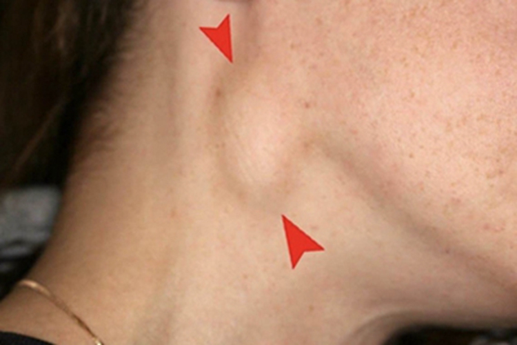 慢性扁桃体炎颈部小疙瘩图