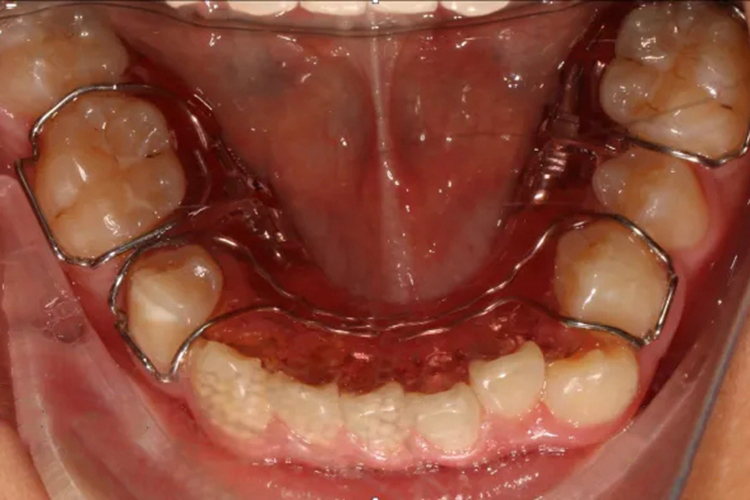 下颌扩弓正畸图