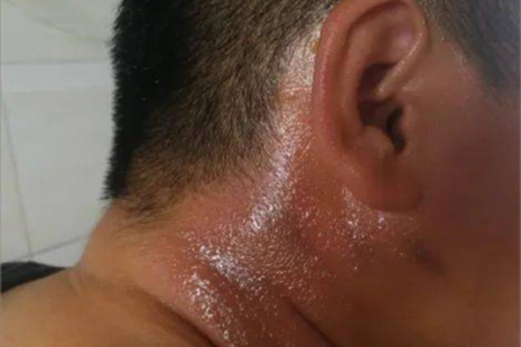 Ⅰ度烧伤症状图 Ⅰ度烧伤症状图