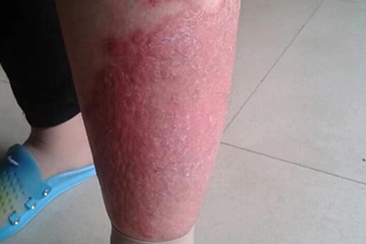银屑病小腿皮肤增厚图