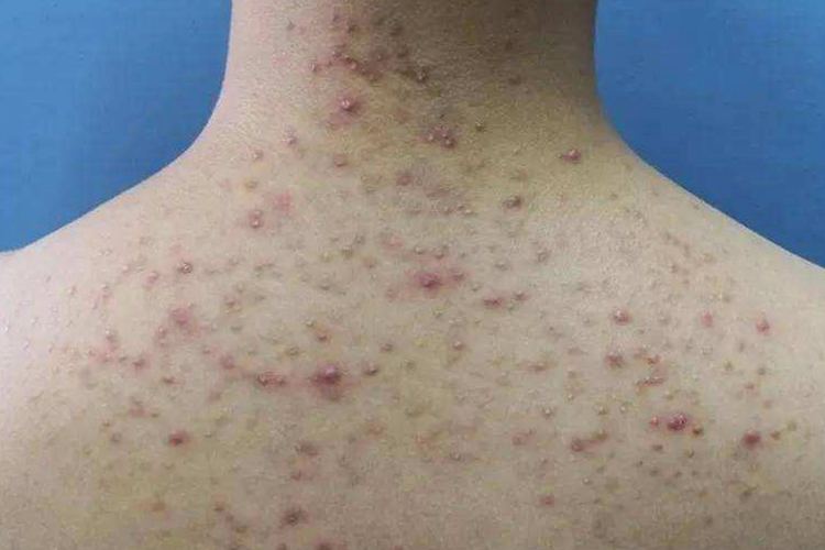 艾滋病期毛囊炎长疮图