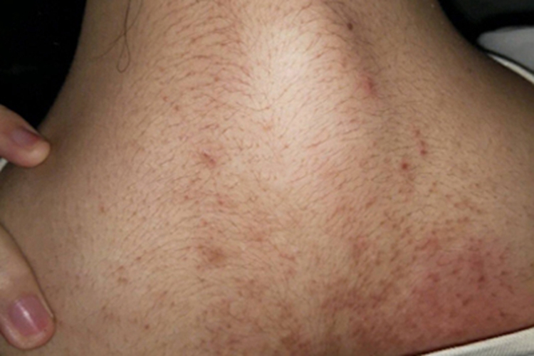 马拉色菌毛囊炎背上有红疙瘩图 马拉色菌毛囊炎背上有红疙瘩图