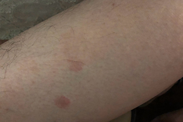 体癣腿上长了两个淡红色斑图