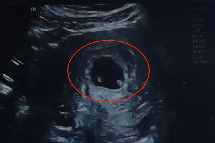 一个孕囊双胞胎B超图