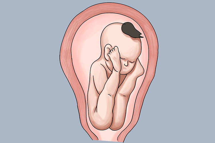 胎儿臀部先露图 胎儿臀部先露图