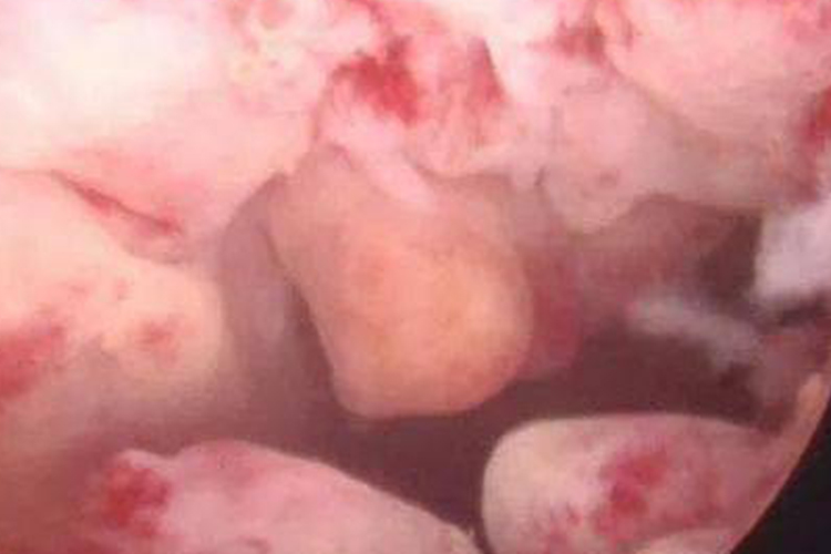 子宫内膜长满息肉图