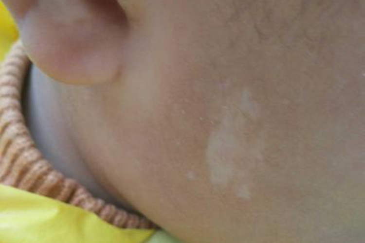 花斑糠疹图 花斑糠疹图