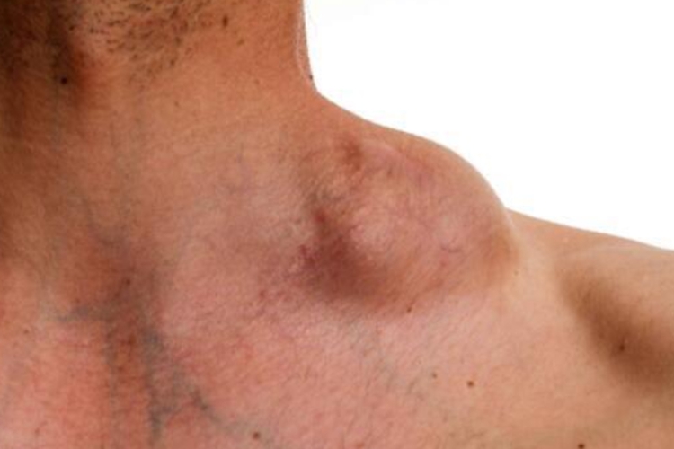 肩膀上脂肪瘤图 肩膀上脂肪瘤图