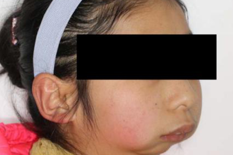 小颌畸形综合征鸟嘴畸形图