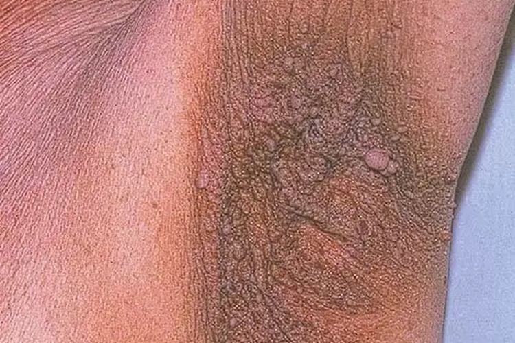 腋下黑棘皮病图