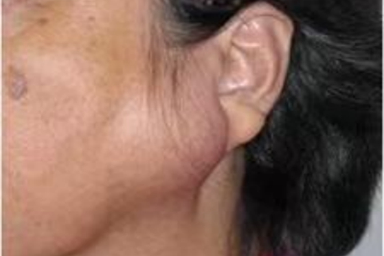 霍奇金病包块图