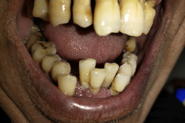 牙周炎症状图 牙周炎症状图