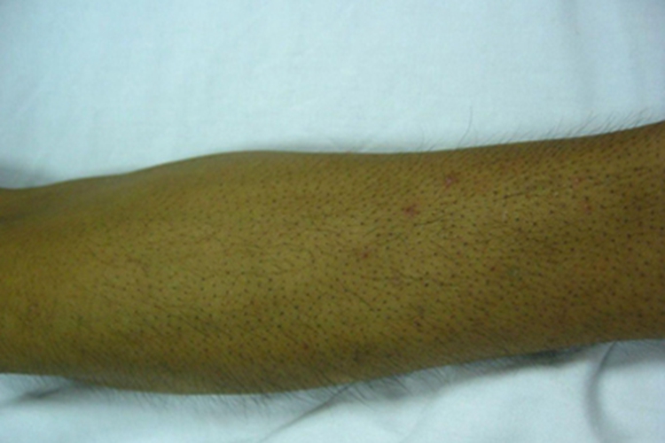 小棘毛壅病胳膊症状图