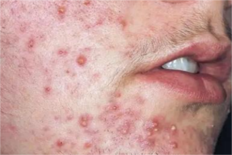 暴发性玫瑰痤疮面部脓包图