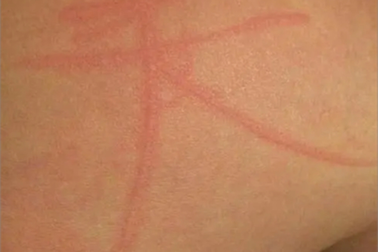 人工荨麻疹大腿症状图