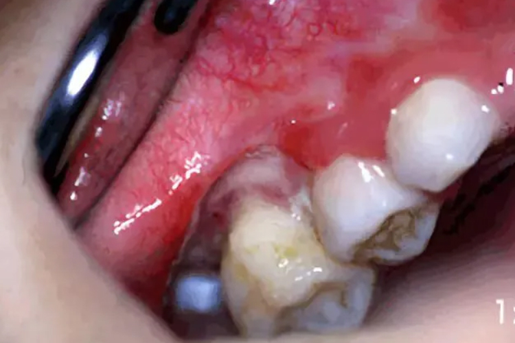 白血病牙龈肿胀和增生图