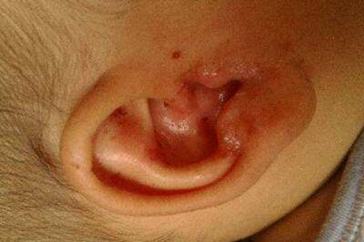 外耳湿疹外耳道流脓图 外耳湿疹外耳道流脓图