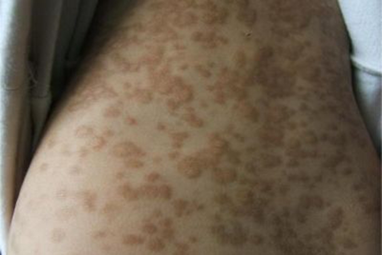 色素性荨麻疹背部斑图 色素性荨麻疹背部斑图