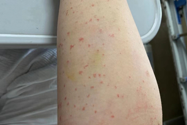 冷球蛋白血症性紫癜胳膊红点图