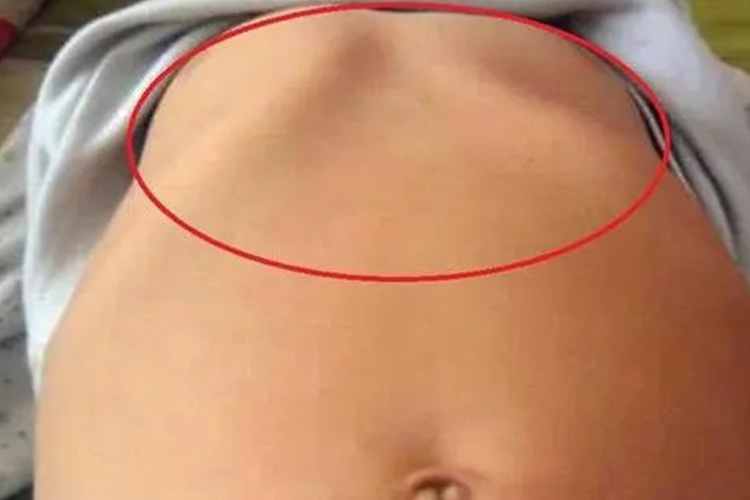 佝偻病胸部轻微凹陷图