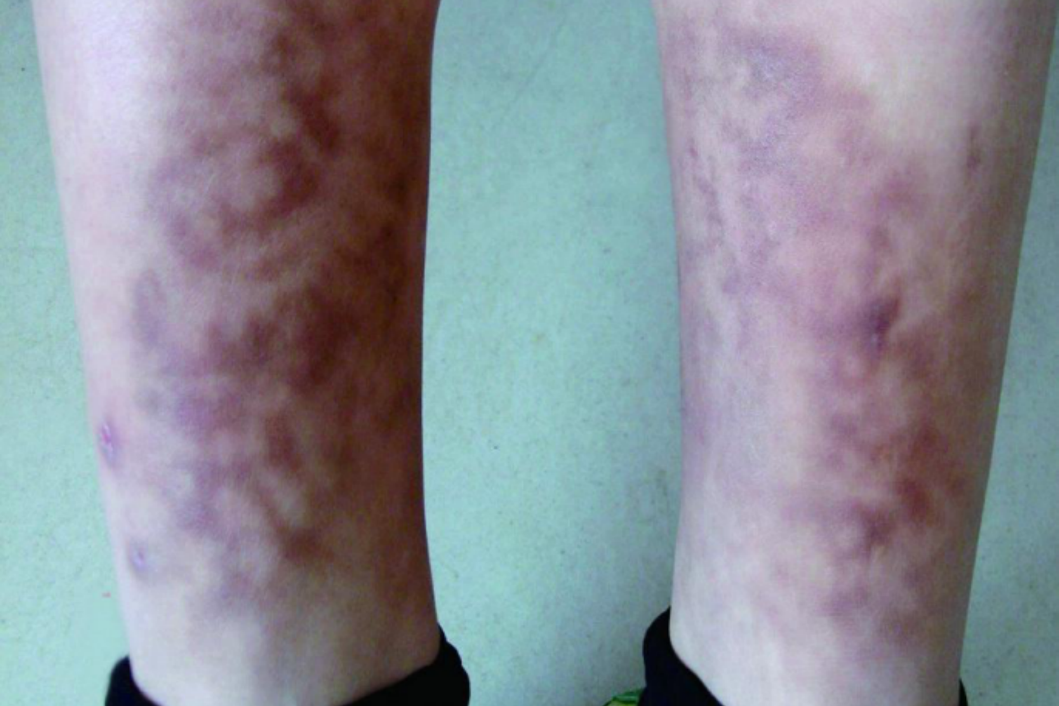 火毒疮网状红斑图