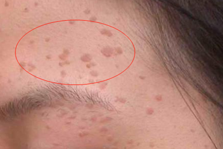 脸上扁平疣初期图