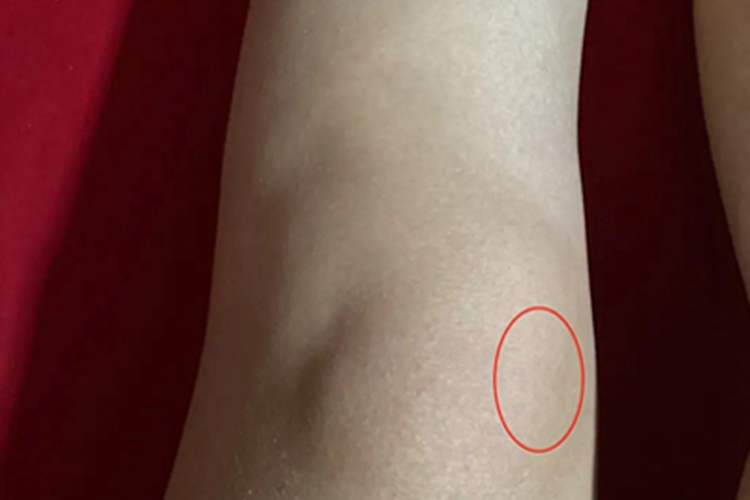 胫骨内侧髁图 胫骨内侧髁图