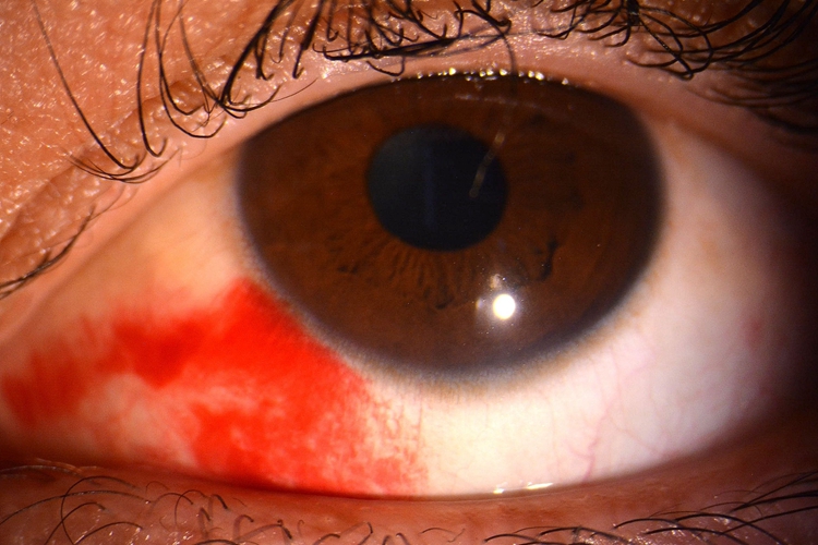 球结膜下出血图