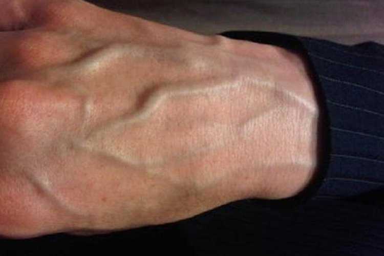 手背血管正常突出明显图