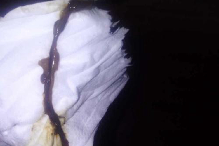 功能失调性子宫出血白带图 功能失调性子宫出血白带图