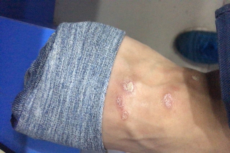 革螨皮炎脚背症状图 革螨皮炎脚背症状图