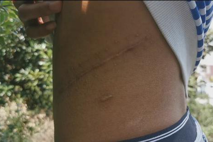 肾脏手术切除12肋腰刀口图