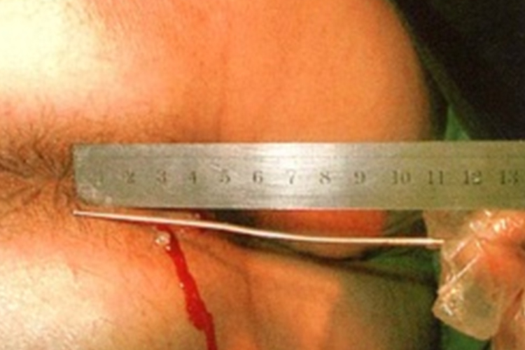 肛瘘早期肛周瘘口图