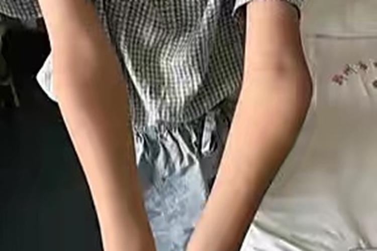 手臂外翻和正常图 手臂外翻和正常图