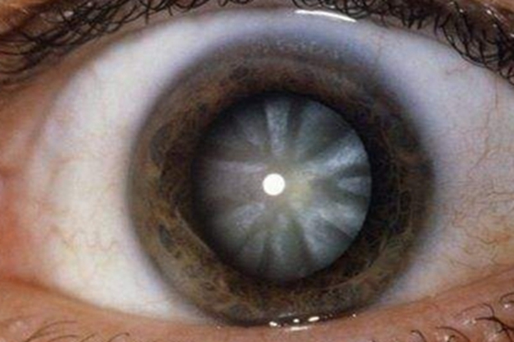 手足搐搦性白内障眼球白斑图