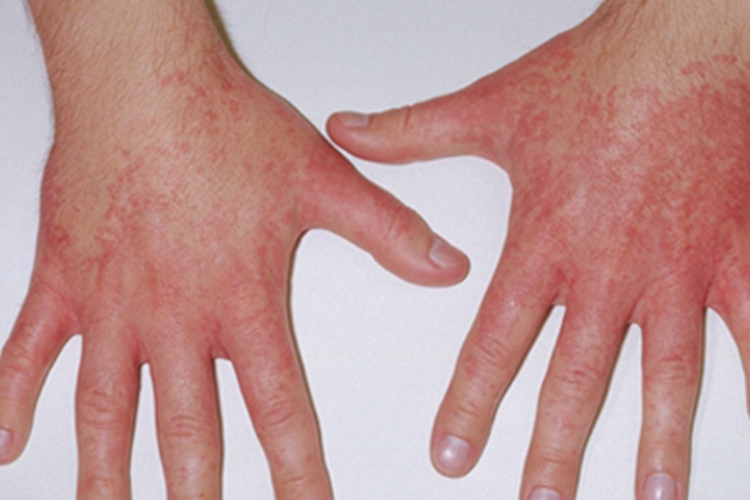 荨麻疹性血管炎手背红斑图