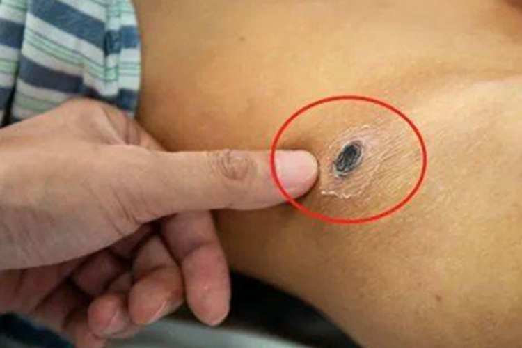 恙虫病腰上有一块焦痂图