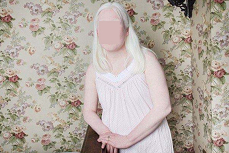 外阴白化病症状图