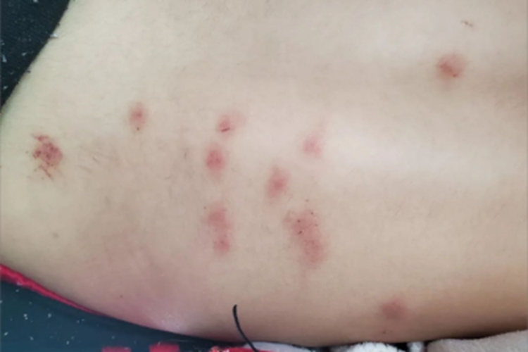蠓叮咬背部起大红疙瘩图 蠓叮咬背部起大红疙瘩图