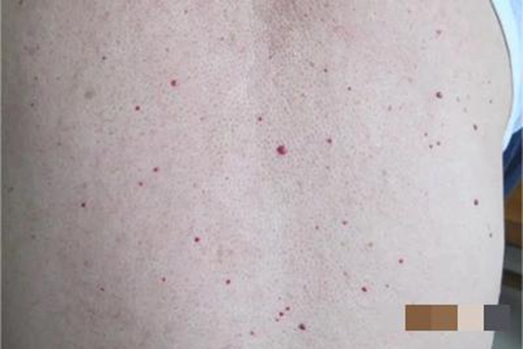 樱桃状血管瘤背部疙瘩图