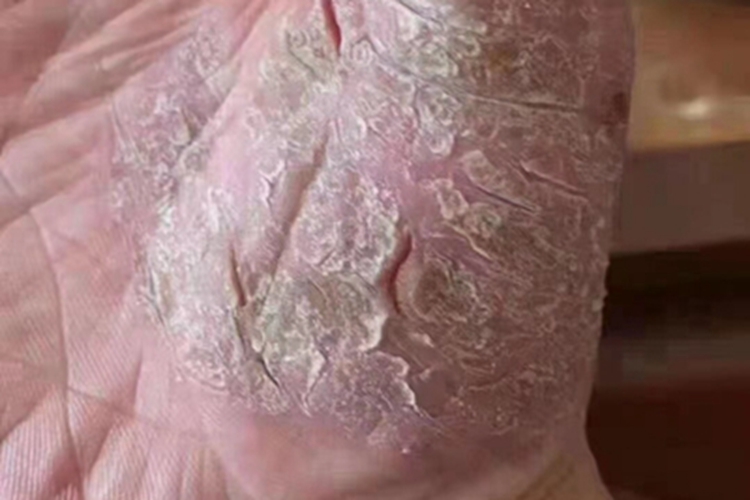 Ⅱ度皮肤皲裂症状图