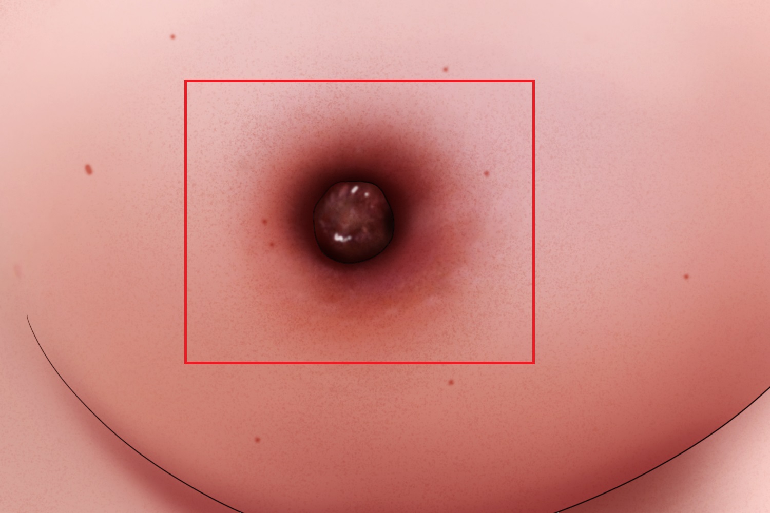 乳腺癌乳房酒窝征手绘图