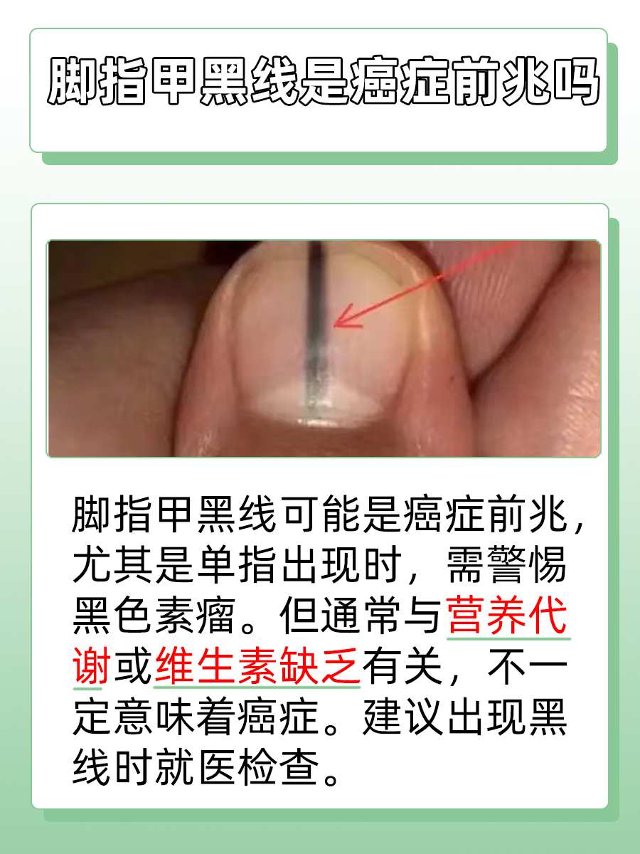 黑甲预警：脚指甲黑线与癌症风险