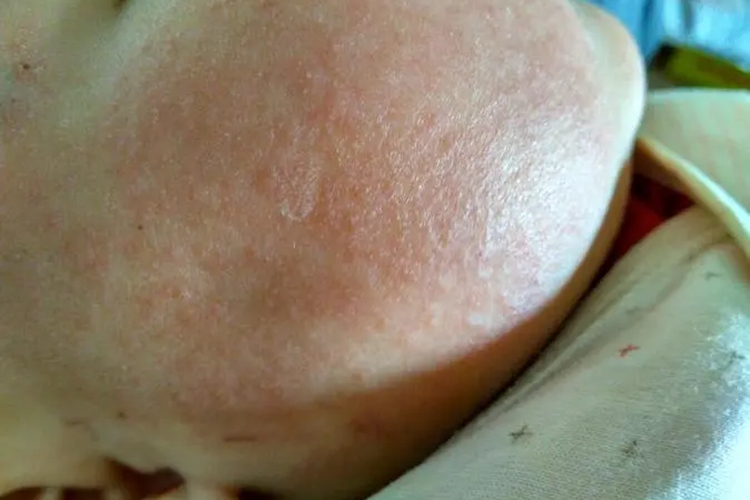 新生儿慢性湿疹图